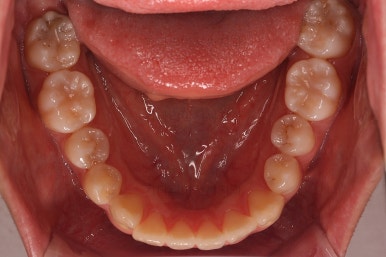 부산치아교정추천