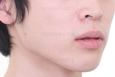 부산돌출입교정