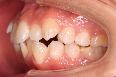 부산청소년치아교정