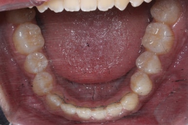 부산주걱턱교정