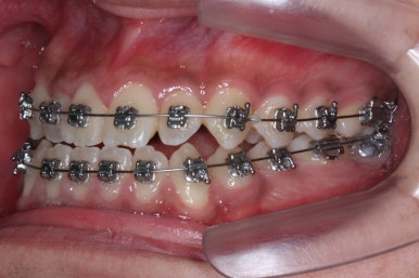 부산주걱턱교정