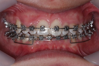 부산왜소치교정