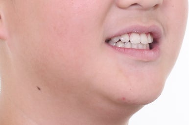 부산비발치교정