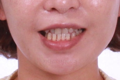 부산연산동교정치과