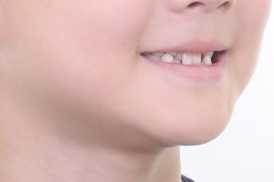 부산어린이치아교정