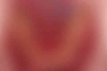 부산연산동사랑니발치