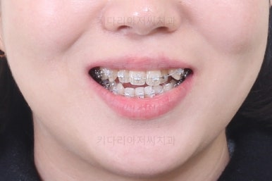 부산치아교정잘하는곳