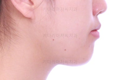 부산비발치교정