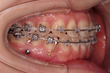 부산치아교정추천