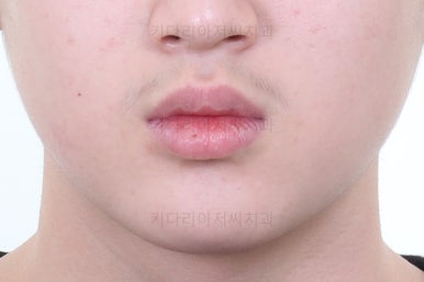 부산연산동사랑니발치