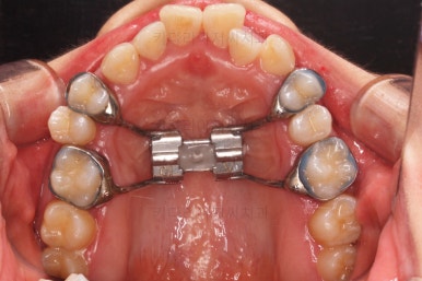 부산비발치교정