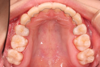 부산클리피씨교정