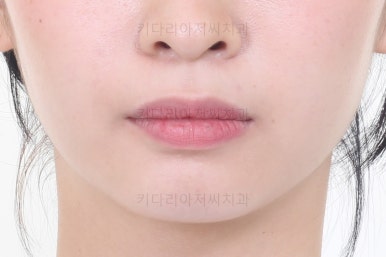 부산돌출입교정