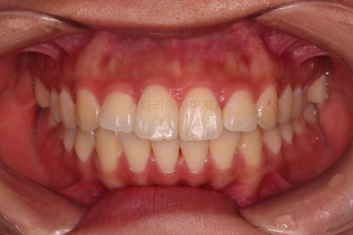 부산연산역치아교정