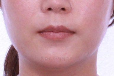 부산치아교정비용