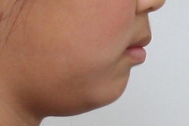 연산동덧니교정