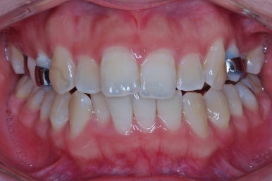 부산비대칭교정