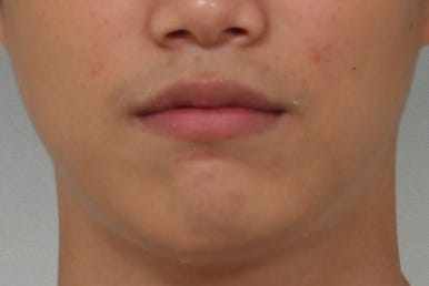 부산왜소치교정