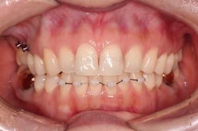 부산치아교정비용