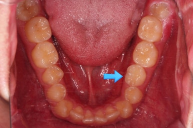 부산주걱턱교정