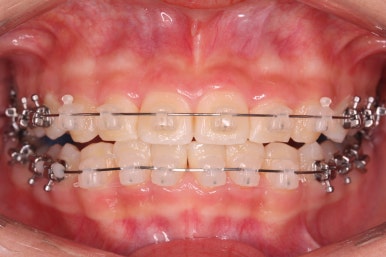 부산치아교정잘하는곳