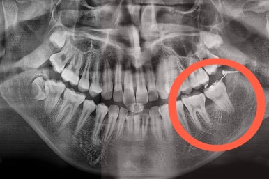 부산연산동사랑니발치