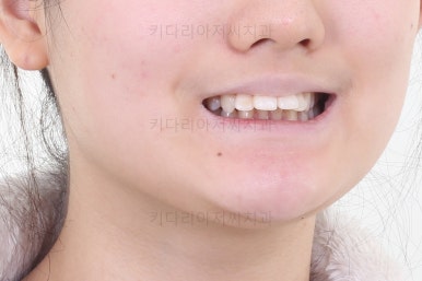 연산동치아교정