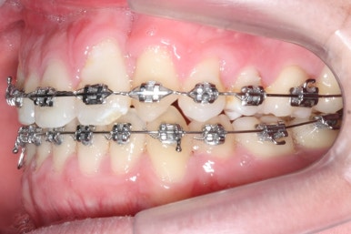 부산구순구개열