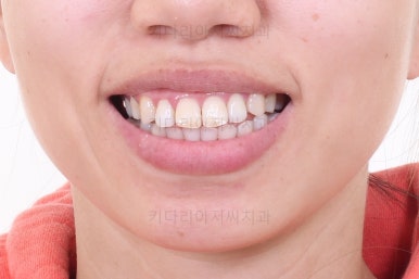 부산치아교정