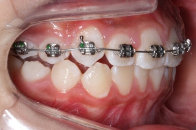 연산동덧니교정