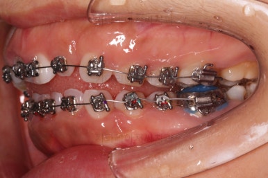 부산구순구개열