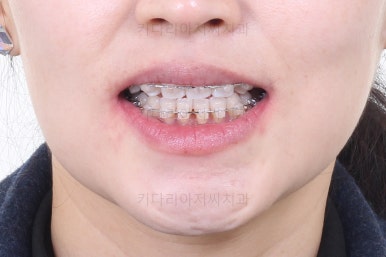 연산동교정치과