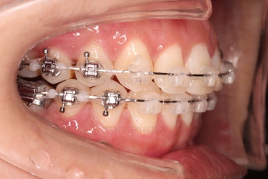부산사랑니교정