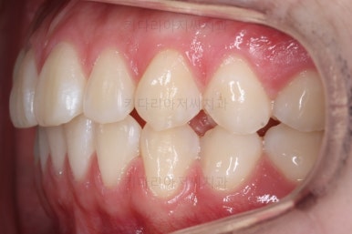 부산치아교정잘하는곳