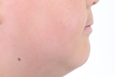 부산비발치교정