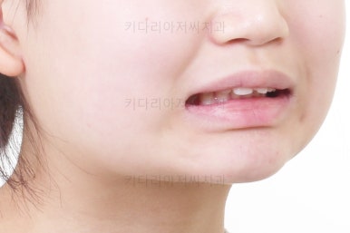 부산어린이치아교정