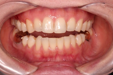 부산치아교정비용