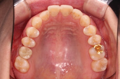 부산치아교정비용