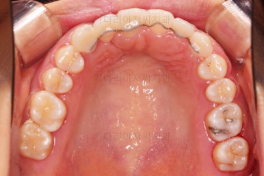 부산구순구개열