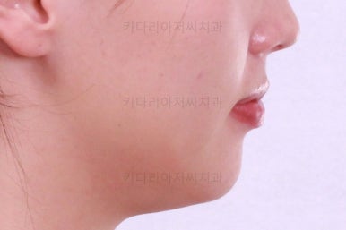 부산비대칭교정