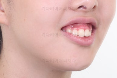 부산투명교정