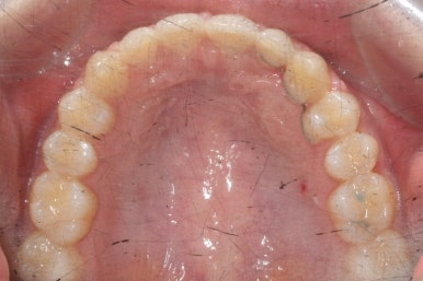 부산매복치아교정