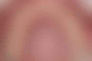 부산매복치아교정