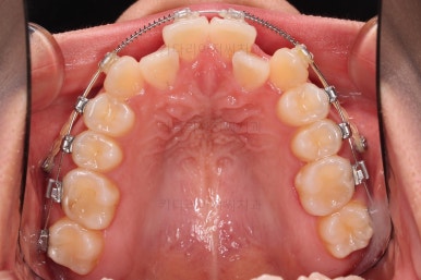 부산비발치교정