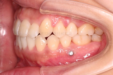 부산비발치교정