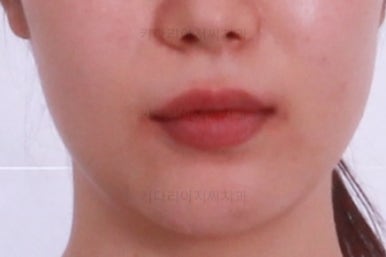 부산부분치아교정