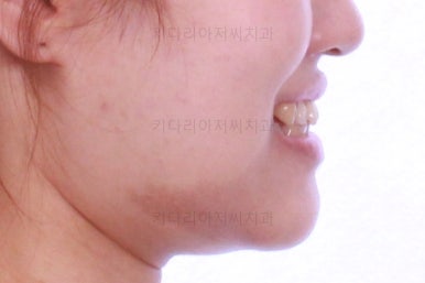 부산치아교정잘하는곳