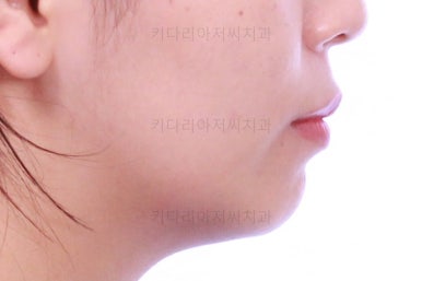 부산사랑니교정