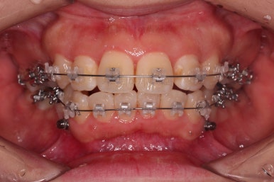 부산무턱교정치과