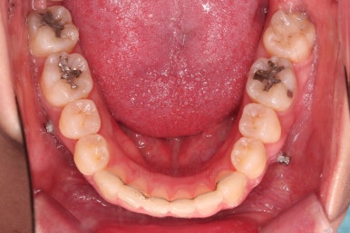 부산비대칭교정